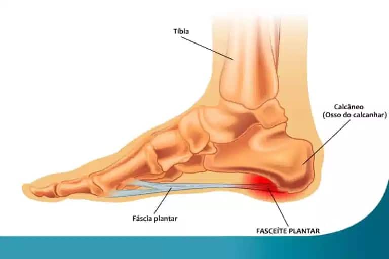 Entenda a fasceíte plantar